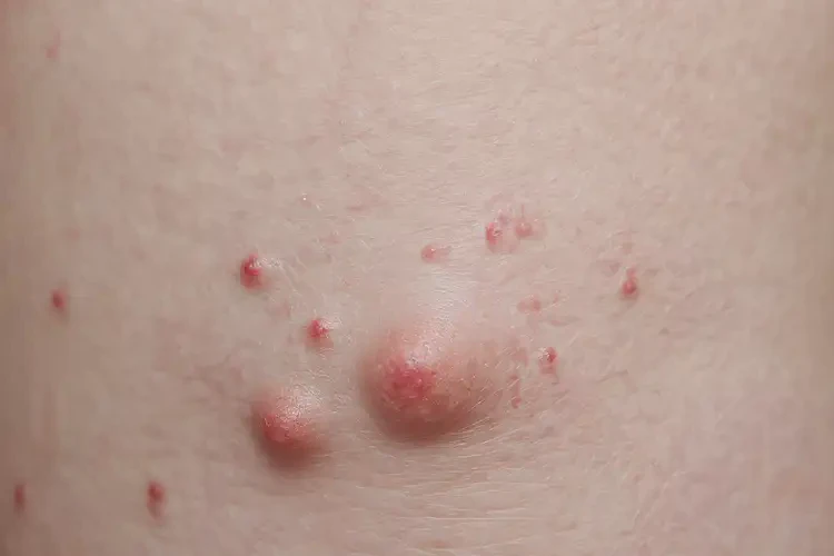 兒童肛周容易長濕疹可以徹底自愈嗎(圖4)