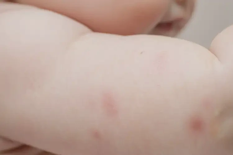 寶寶手臂出濕疹能徹底自愈嗎(圖3)