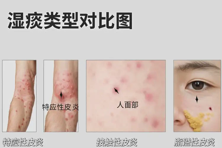 兒童全身經(jīng)常起濕疹可不可以徹底自愈(圖3)