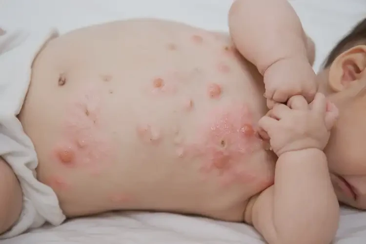 小兒肚子容易起濕疹不管它會(huì)自己痊愈嗎(圖4)