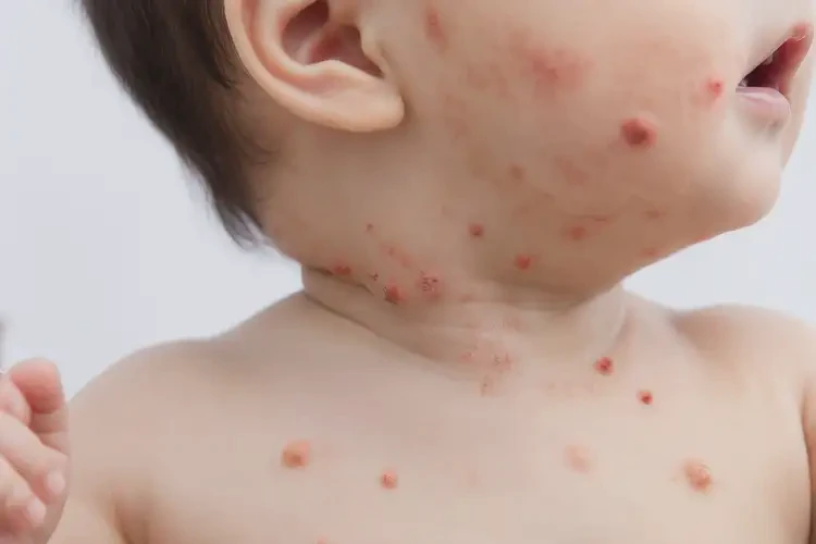 小兒脖子上容易長(zhǎng)濕疹不管它會(huì)自己好嗎(圖4)