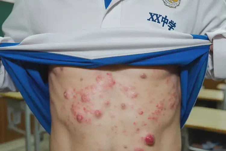 中學(xué)生肚子偶爾起濕疹不管它會(huì)自己痊愈嗎(圖2)