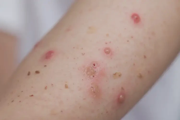 少兒手臂上經(jīng)常起濕疹可以徹底自愈嗎(圖4)