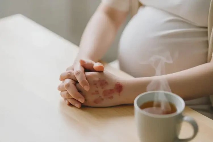 產(chǎn)婦手上出濕疹能徹底自愈嗎(圖2)