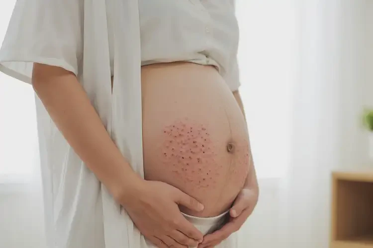 孕婦肚子偶爾長濕疹不管它會自己痊愈嗎(圖4)