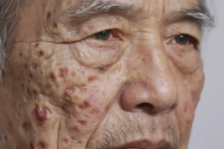 老年人全身出濕疹能不能徹底自愈(圖4)