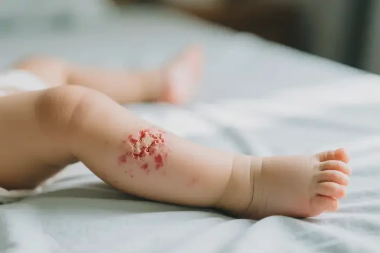 幼兒大腿出現(xiàn)濕疹不管它會自己好嗎(圖1)