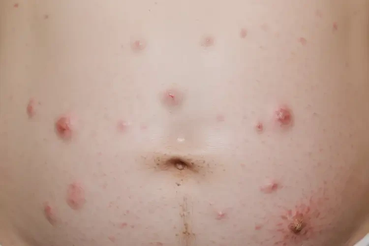 產(chǎn)婦肚子上出現(xiàn)濕疹不管它會自己痊愈嗎(圖4)