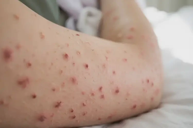 產(chǎn)婦手臂上出濕疹不管它會(huì)自己好嗎(圖4)