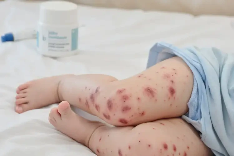 寶寶大腿容易起濕疹不管它會自己好嗎(圖4)