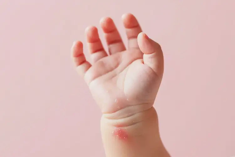 嬰兒手臂上出現(xiàn)濕疹不管它會自己痊愈嗎(圖2)