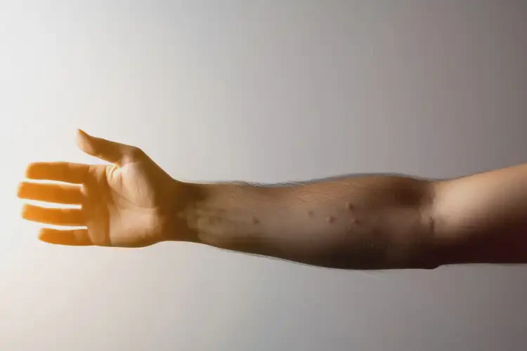 男生手臂偶爾起濕疹能靠自己自愈嗎(圖3)