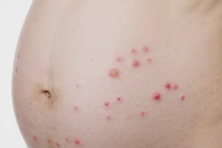 產(chǎn)婦肚子偶爾起濕疹能靠自己自愈嗎(圖3)