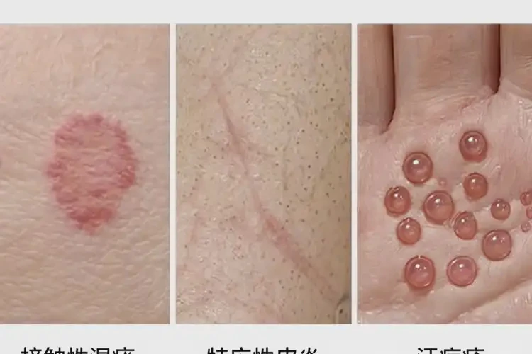 女性脚上经常起湿疹不管它会自己好吗(图3)