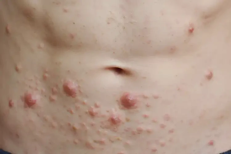 中學(xué)生肚子經(jīng)常起濕疹不管它會(huì)自己痊愈嗎(圖4)