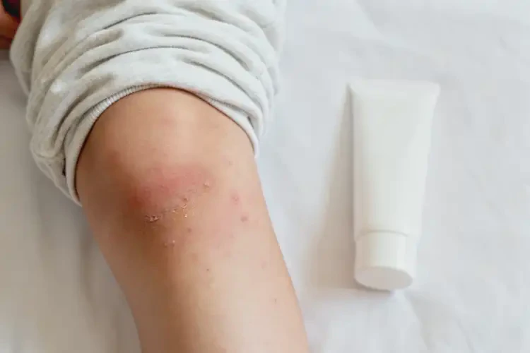 青少年大腿起濕疹可不可以徹底自愈(圖4)