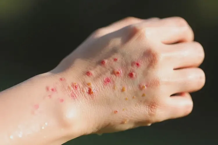 女人手臂出濕疹可以徹底自愈嗎(圖3)