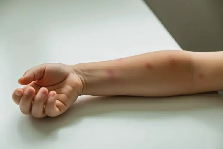 孩子手臂有濕疹不管它會自己自愈嗎(圖3)