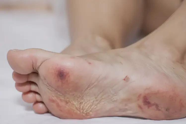 產(chǎn)婦腳上出現(xiàn)濕疹不管它會(huì)自己自愈嗎(圖4)