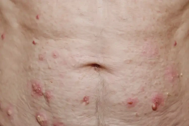 老年人肚子上偶爾起濕疹能夠徹底治愈嗎(圖4)