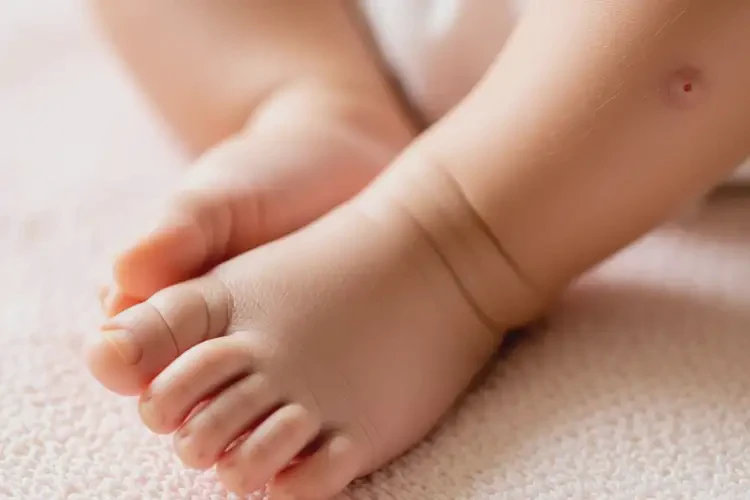 嬰兒腳上長(zhǎng)濕疹可以徹底自愈嗎