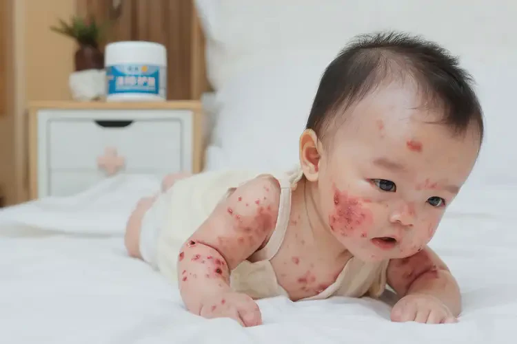 寶寶身上出現(xiàn)濕疹不管它會(huì)自己自愈嗎(圖4)