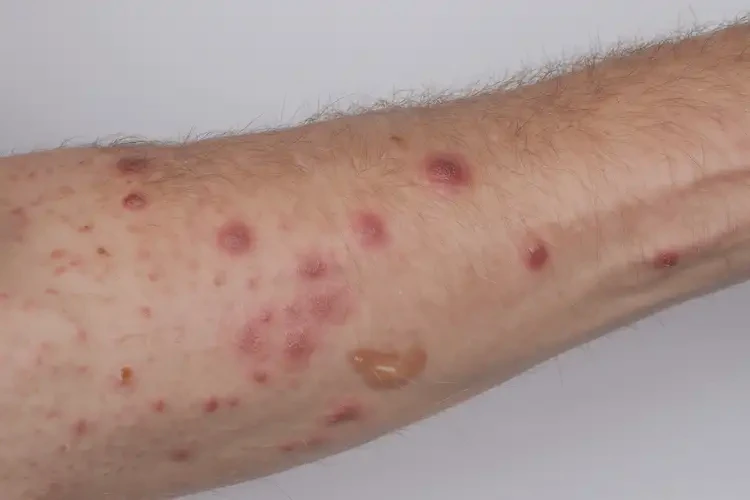 青年人手臂上起湿疹能够彻底治愈吗(图4)