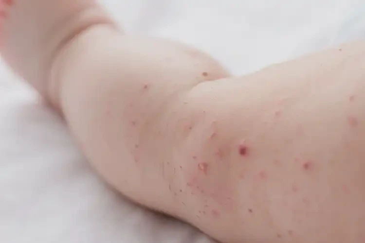 嬰兒小腿上偶爾長(zhǎng)濕疹能徹底自愈嗎(圖3)