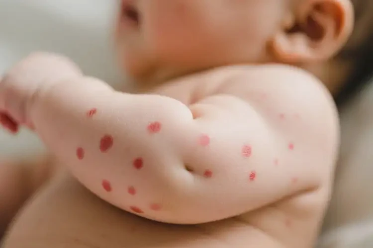 嬰幼兒手臂偶爾長濕疹不管它會(huì)自己好嗎(圖2)