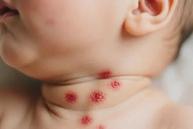 寶寶脖子出現(xiàn)濕疹不管它會自己痊愈嗎(圖4)