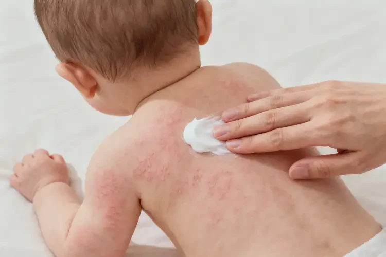 嬰兒全身容易長(zhǎng)濕疹不管它會(huì)自己痊愈嗎(圖2)