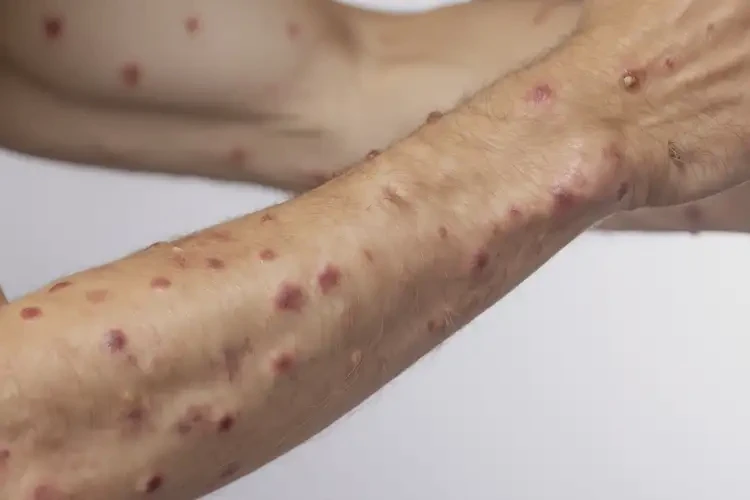 男生手臂出濕疹能徹底自愈嗎(圖4)