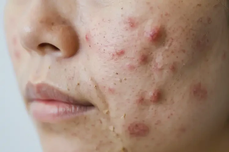 大學(xué)生面部出濕疹能不能徹底自愈(圖4)