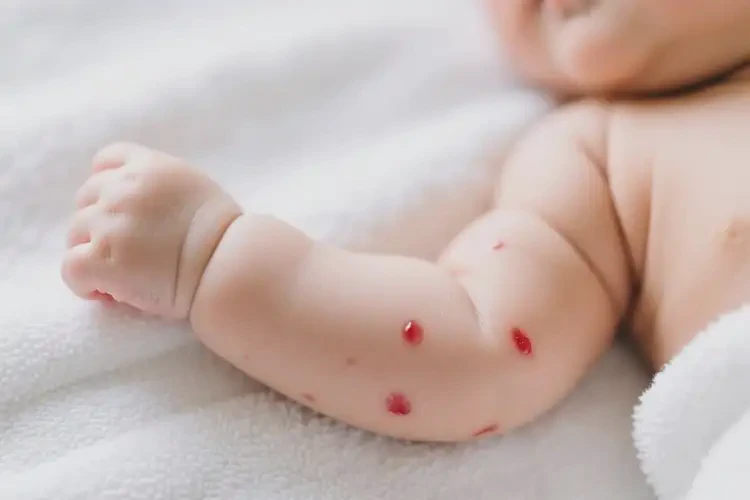 嬰兒手臂偶爾長(zhǎng)濕疹能夠徹底治愈嗎(圖3)