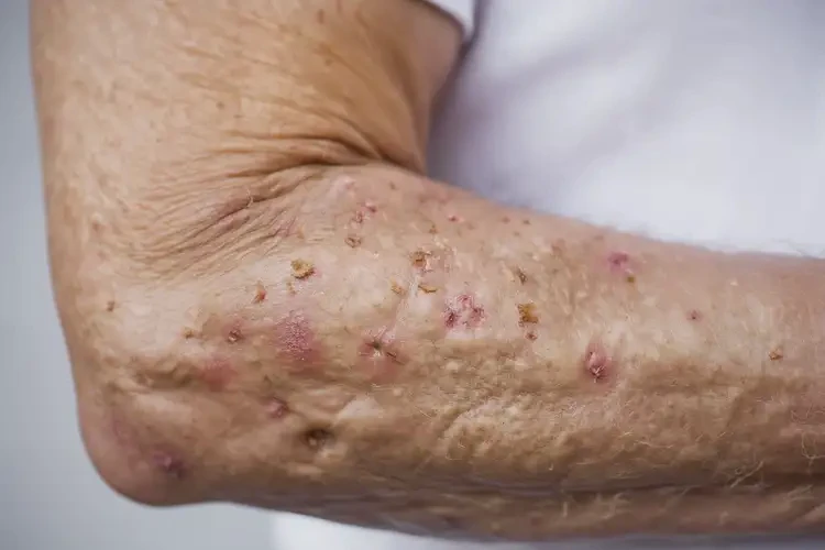 老人手臂出濕疹能靠自己自愈嗎(圖4)