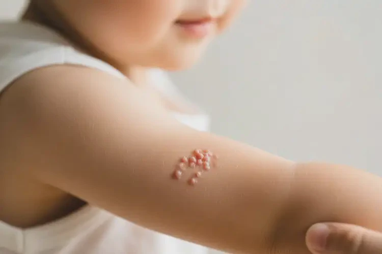 少兒手臂上容易起濕疹可不可以徹底自愈(圖4)