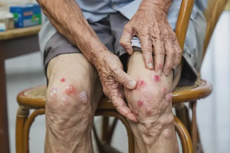 老人大腿上有濕疹不管它會自己自愈嗎(圖4)