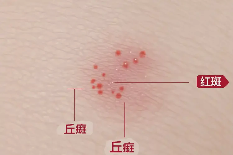 女性肛周偶爾起濕疹不管它會自己好嗎(圖4)