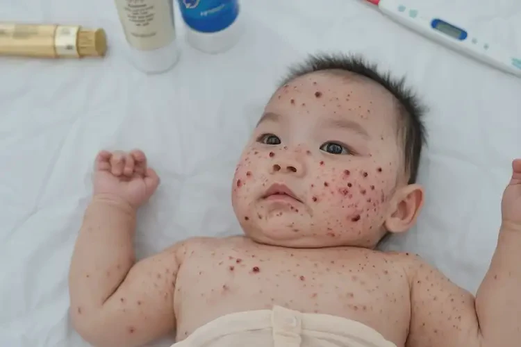 嬰兒屁股上經(jīng)常起濕疹可以徹底自愈嗎(圖4)