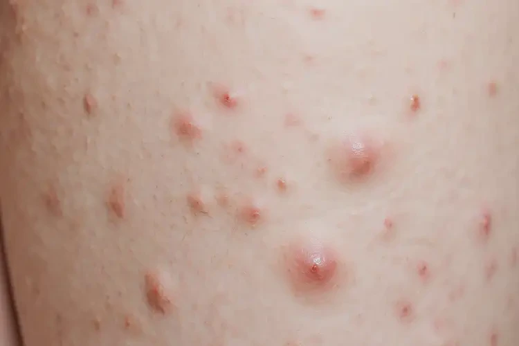 女性大腿上經(jīng)常起濕疹可以徹底自愈嗎(圖4)