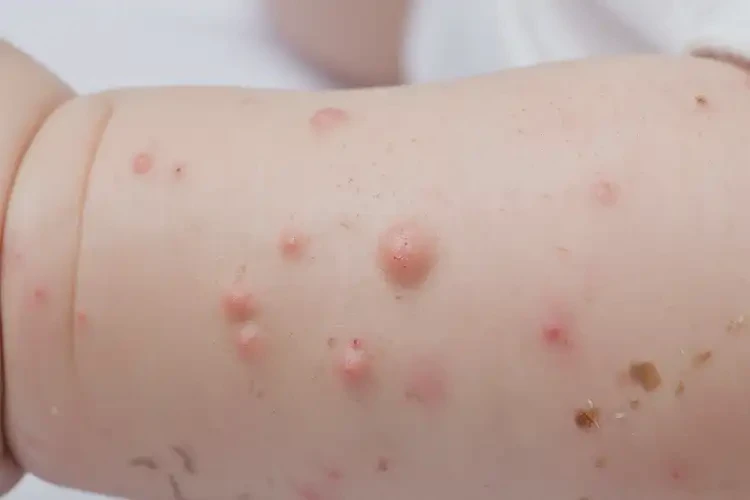 嬰幼兒手臂上起濕疹能夠徹底治愈嗎(圖4)