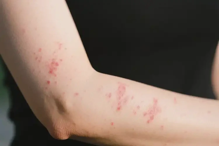 女性手臂上偶爾起濕疹能徹底自愈嗎(圖1)