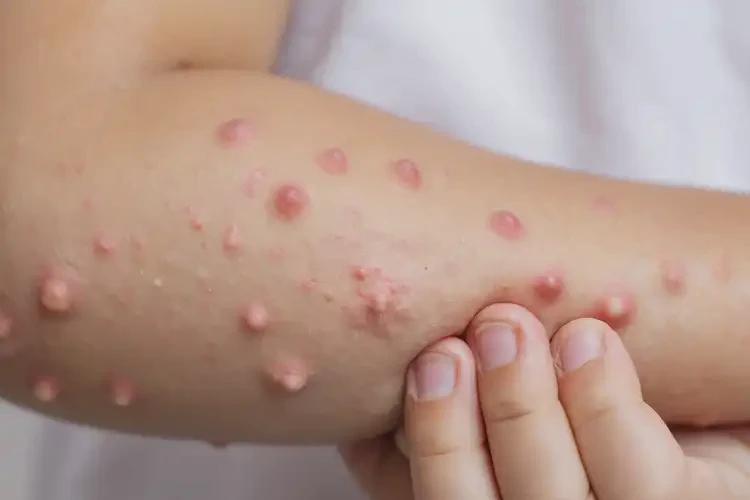 小孩全身容易起濕疹能靠自己自愈嗎(圖4)