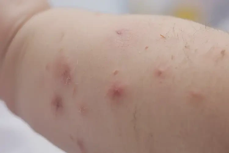 幼兒全身容易起濕疹不管它會自己自愈嗎(圖4)