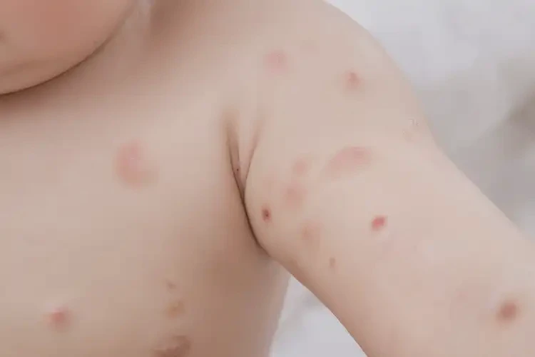 寶寶手臂上偶爾起濕疹不管它會自己自愈嗎(圖4)