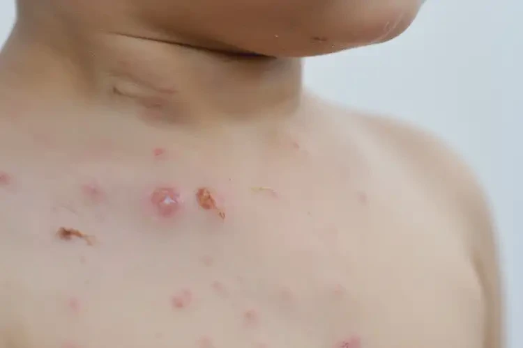 小儿脖子出现湿疹能靠自己自愈吗(图4)