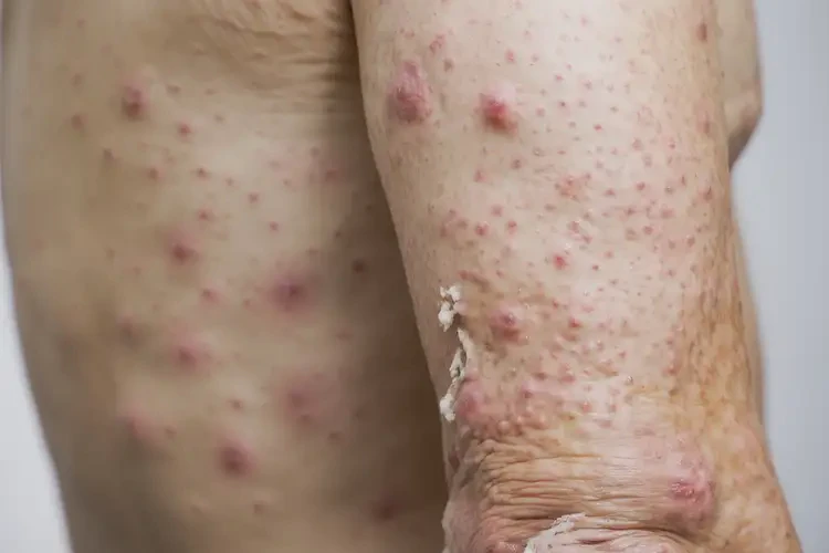 男人全身經(jīng)常起濕疹不管它會(huì)自己好嗎(圖4)