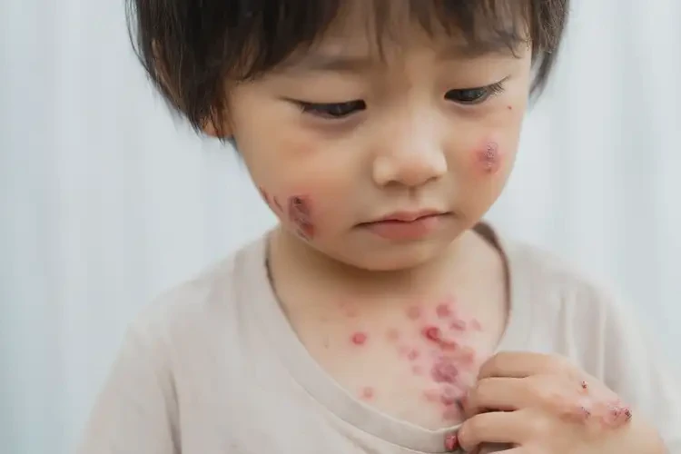 少兒脖子上經(jīng)常長濕疹不管它會自己好嗎(圖4)