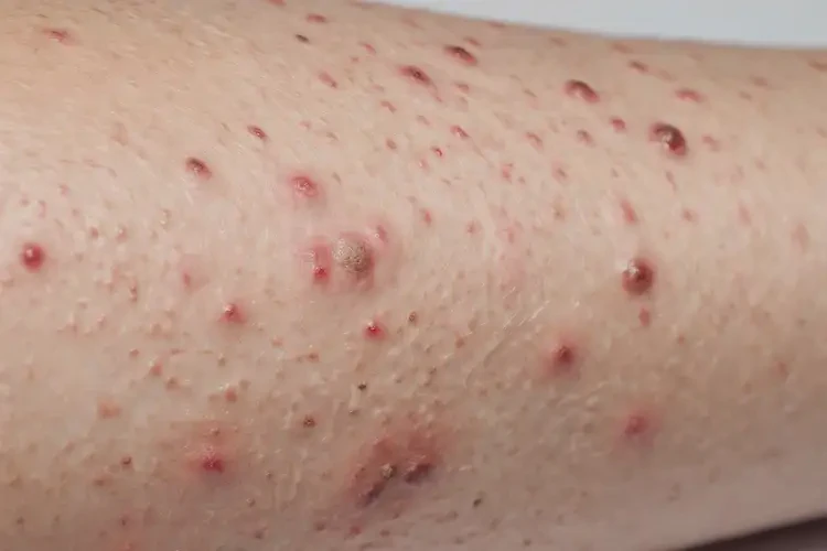 青少年四肢出濕疹可以徹底自愈嗎(圖4)