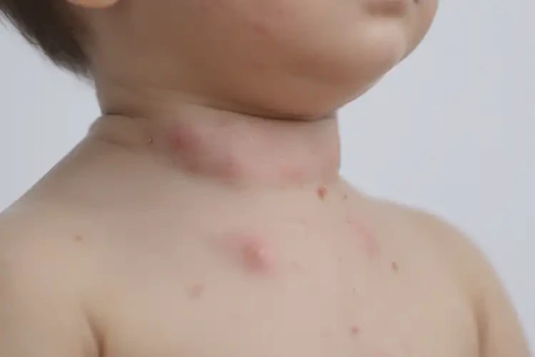 幼兒脖子上偶爾起濕疹能徹底自愈嗎(圖4)